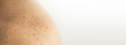 What are moles and when should you get them checked